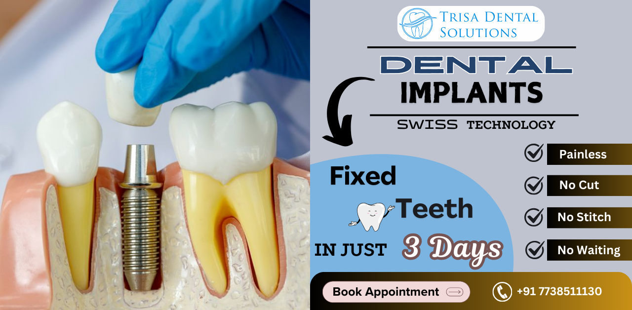 Dental Implants