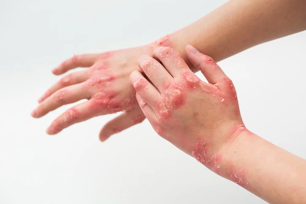 Psoriasis Ayurvedic Treatment